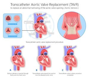 TAVR Centre of Excellence