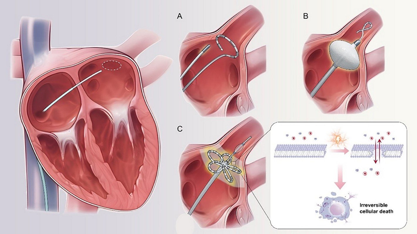 Pulsed-Field-Ablation_in_Chennai