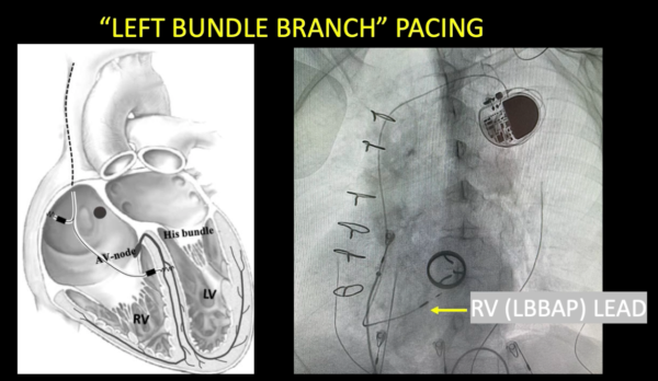 pacemaker implantation in chennai